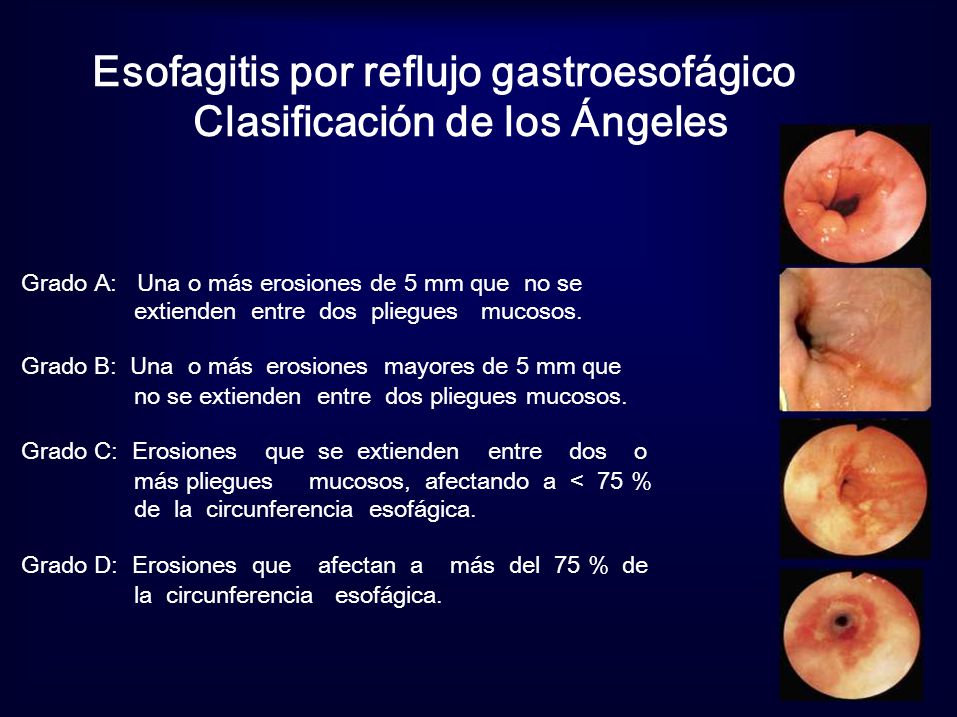 esofagitis grado 3 savary miller